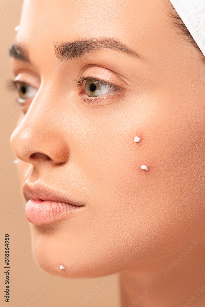 close up of woman with acne on face isolated on beige close up of woman with acne on face isolated on beige