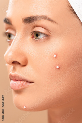 close up of woman with acne on face isolated on beige