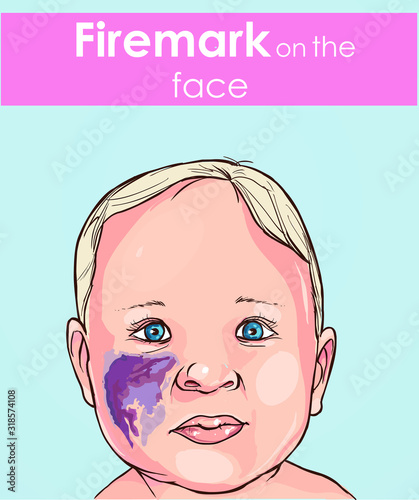 Firemark on the baby face.