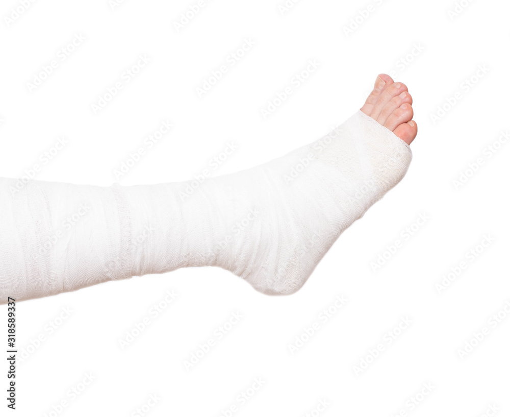 Leg bandaged in a tight dressing, plaster cast for fracture of the