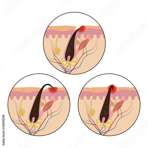 Varieties of ingrown hair. Medical scheme of hair ingrowth. Illustration isolated on a white background for design and web.