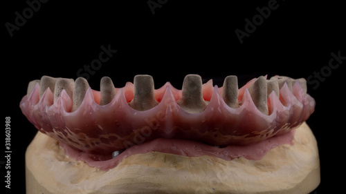 dental implants on a black background