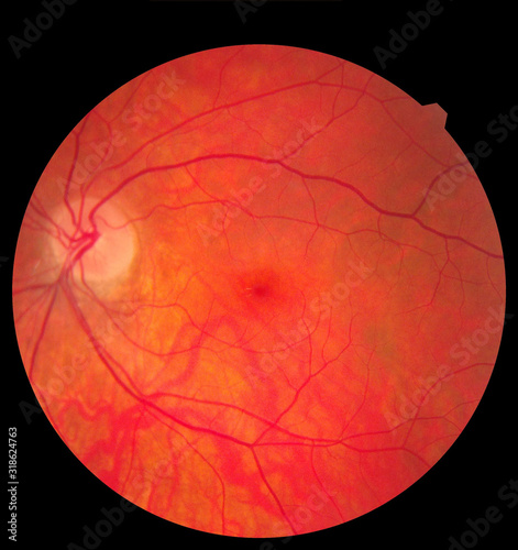 Ophthalmic image detailing the retina and optic nerve inside a healthy human eye. Medicine concept