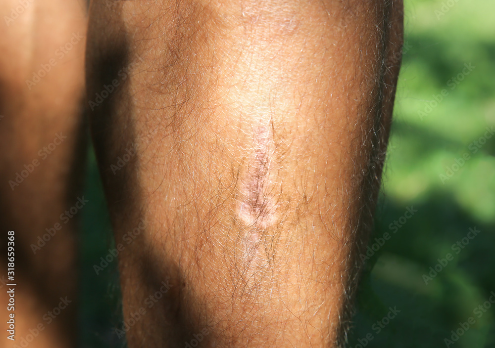 Fototapeta premium Old scar on man's leg. Accident in the past.