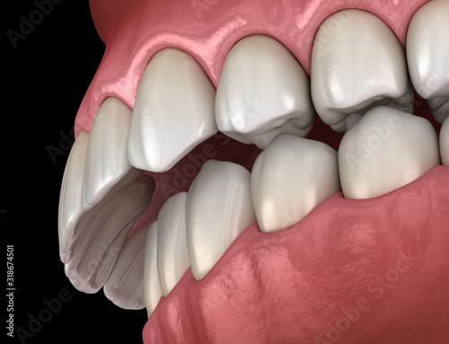 Overbite dental occlusion ( Malocclusion of teeth ). Medically accurate tooth 3D illustration photo