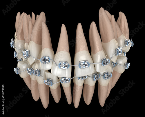 Abnormal teeth position and metal braces tretament. Medically accurate dental 3D illustration photo