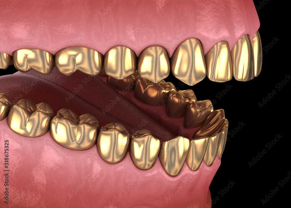 Golden teeth crowns over natural teeth. Medically accurate 3D illustration of human teeth treatment Golden teeth crowns over natural teeth. Medically accurate 3D illustration of human teeth treatment