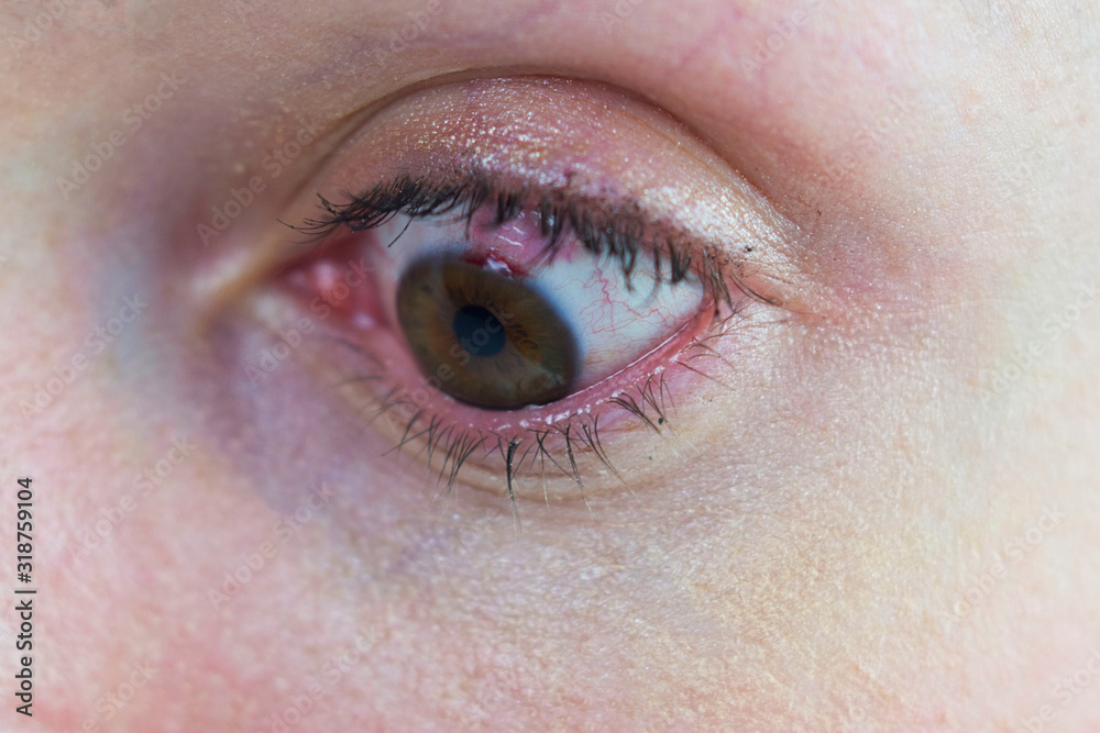 Eye After Lasik Showing Burst Blood Vessel. Laser Eye Damage, Red Blood