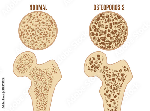 Cartoon Color Osteoporosis Bones Ad Poster Card. Vector photo