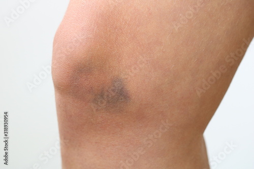 bruises on the woman's knee on white background