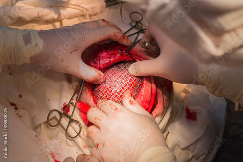 Tablou pe pânză top view, stages of neurosurgical surgery for installing a titanium plate in the patients skull