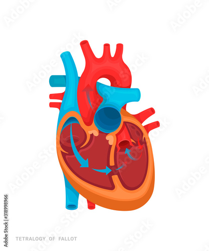 Heart defect. Tetralogy of fallot. Illustration for medicine books, websites, apps. Heart disease with name.
