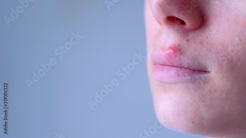Herpes virus on human lips. Woman with herpes sore on lip mouth, closeup view. Process of dehydration during illness. Human papilloma virus, viral infection.