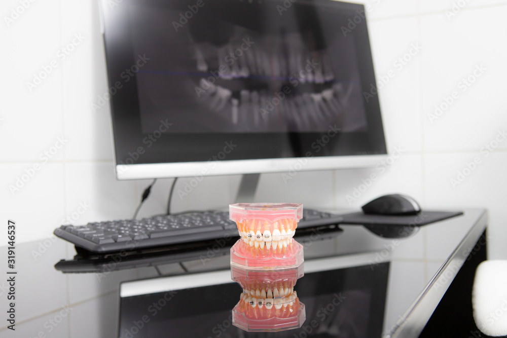 Panoramic xray on computer screen. Model of the jaw on the table Stock