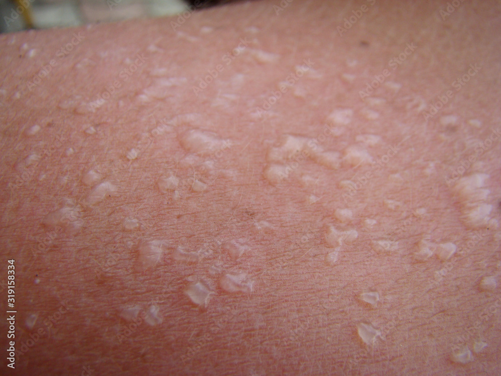 Fototapeta premium sunburn