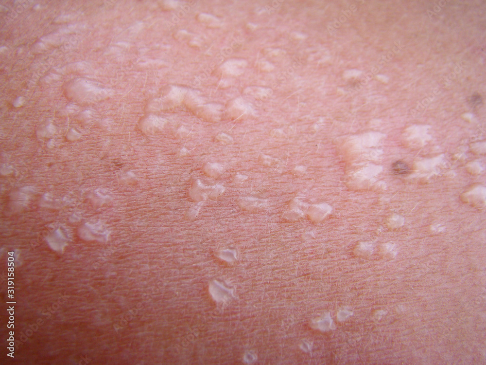 sunburn sunburn