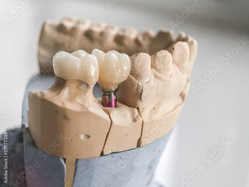 Dental prosthetics on implants, artificial jaw with dentures on the table in the dental office