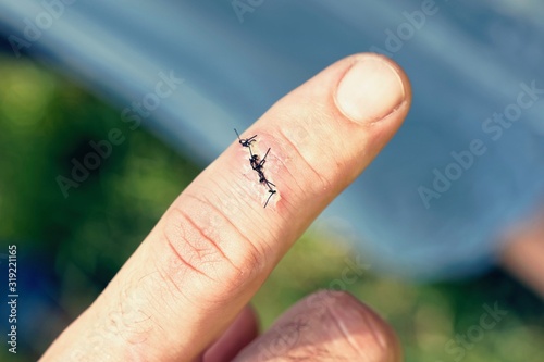 Injured index finger wound with stitches