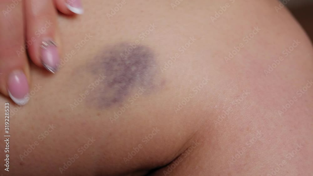 Close-up of a large bruise on a young woman's leg. A woman touches a large hematoma on her leg with her fingers. Domestic violence. Close-up of a large bruise on a young woman's leg. A woman touches a large hematoma on her leg with her fingers. Domestic violence.