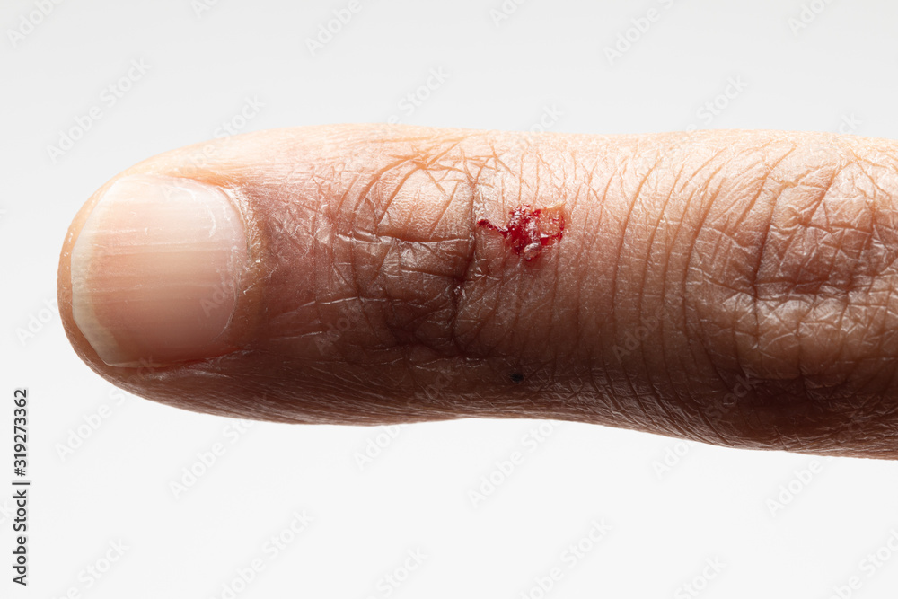 Fototapeta premium skin wounds and healing problems: concept of dermocosmetics