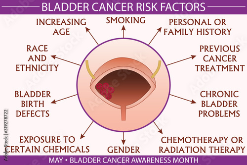 Bladder cancer risk factors infographic vector illustration. Health and healthcare concept design for presentation, banner, brochure, etc. EPS-10 vector, printable cmyk colors.