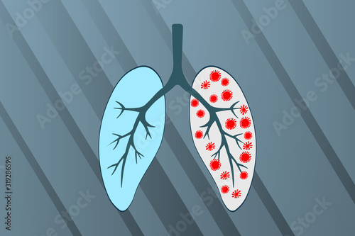 Medical genetics bacteriological Microorganism background. Wuhan Chinese Coronavirus 2019-nCoV. Pneumonia. Bacteria Biology Organisms. Virus infection epidemic sick. Health background. Sick lungs.