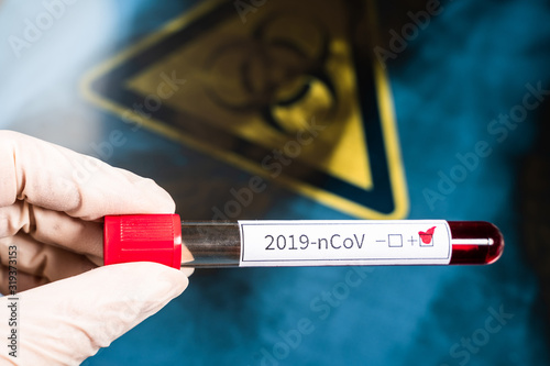 The doctor holds a test tube with blood in his hand. A positive blood test for a new coronavirus. Against the background of an X-ray of a patient with pneumonia and a biohazard sign