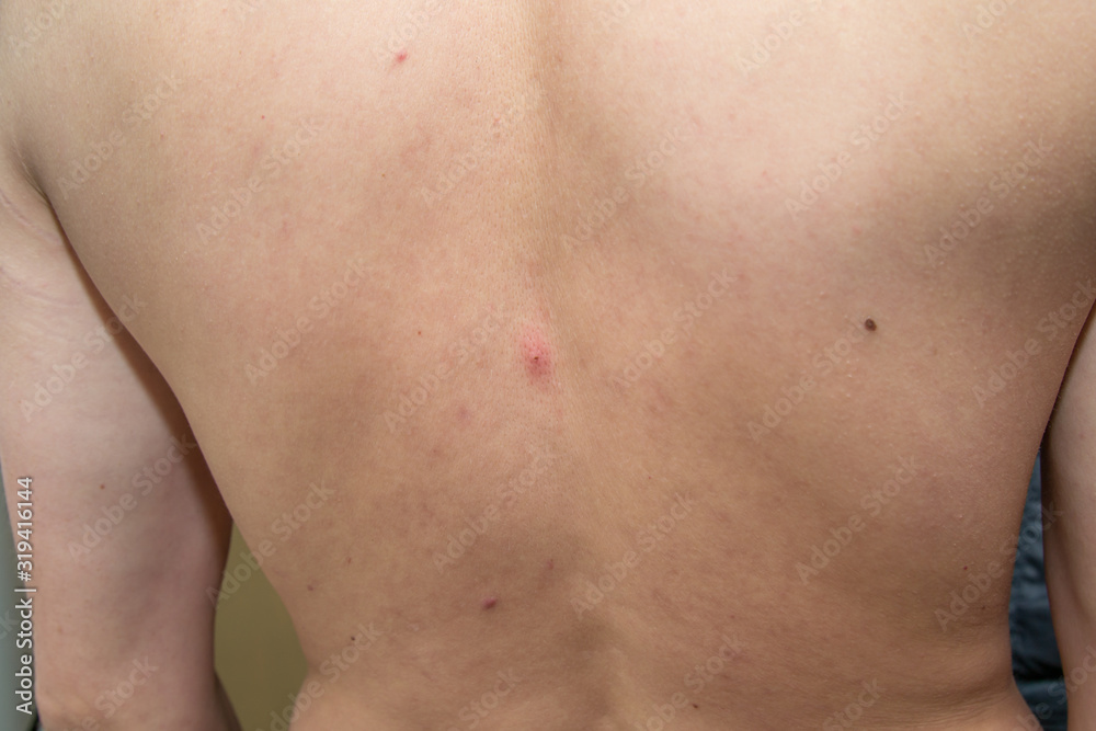 Red pimple on the back of a man right on the spine. Red pimple on the back of a man right on the spine.