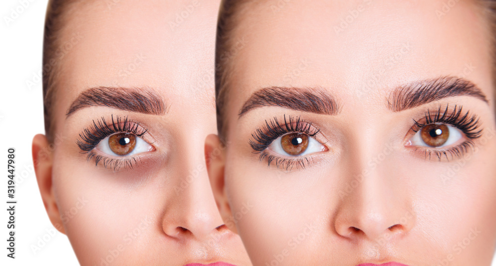 Young blonde woman with bruises under eyes before and after treatment. Young blonde woman with bruises under eyes before and after treatment.
