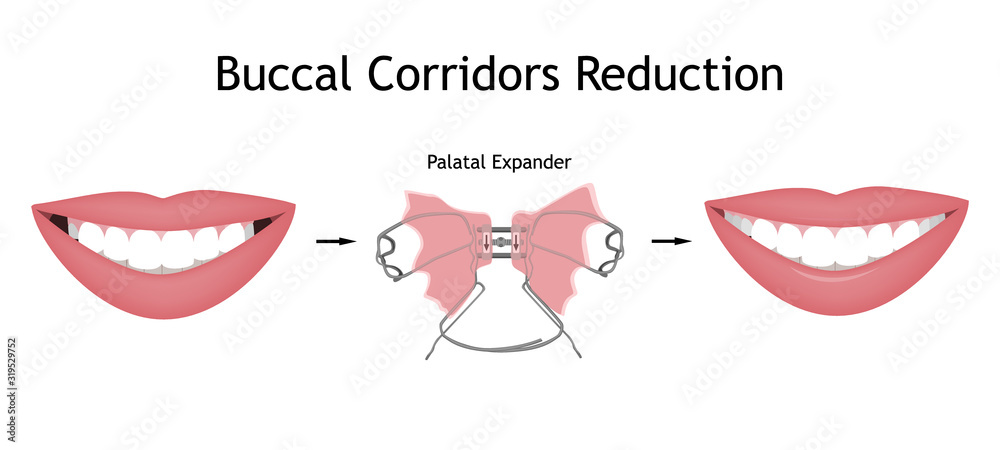 The smile with large and dark buccal corridor before and after the