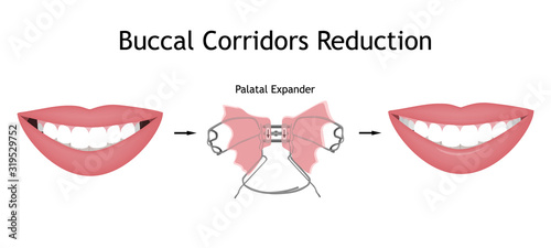 The smile with large and dark buccal corridor before and after the orthotropics or orthotropics correction. Vector illustration. photo