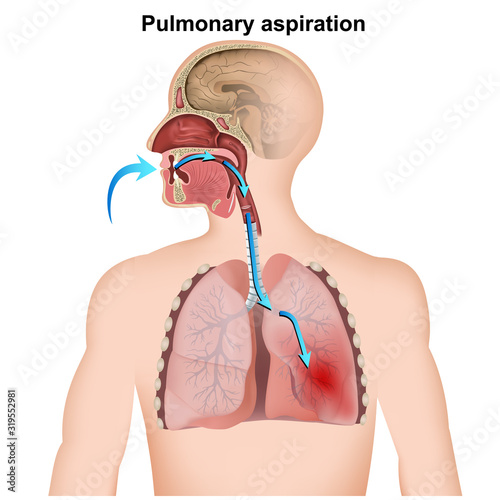 pulmonary aspiration medical infographic  on white background