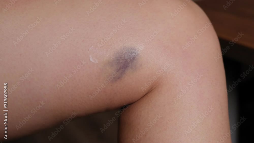 Close-up of a young woman applying therapeutic ointment to a large bruise on her leg. Treatment of hematoma on the skin. Hematoma on the leg. Bruise on the leg. Close-up of a young woman applying therapeutic ointment to a large bruise on her leg. Treatment of hematoma on the skin. Hematoma on the leg. Bruise on the leg.