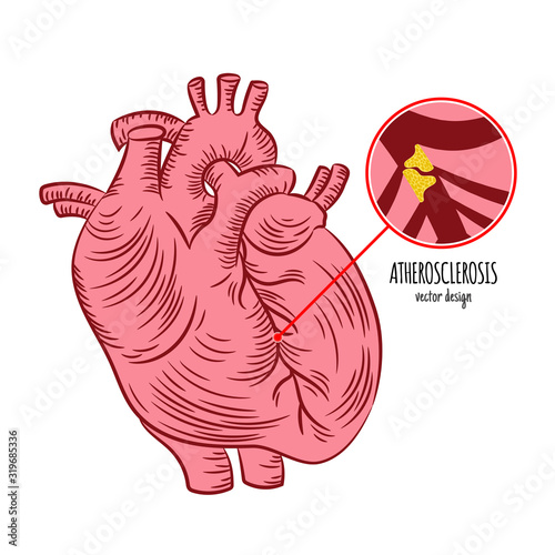 ATHEROSCLEROSIS Chronic Disease Medicine Education Diagram Vector Scheme Human Hand Draw Vector Illustration