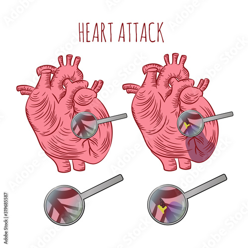 HEART ATTACK Atherosclerosis Chronic Disease Medicine Education Diagram Vector Scheme Human Hand Draw Vector Illustration