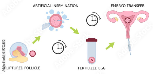 Colored in vitro fertilization IVF flat infographics with steps of additional techniques vector illustration. Ruptured follicle, artificial insem