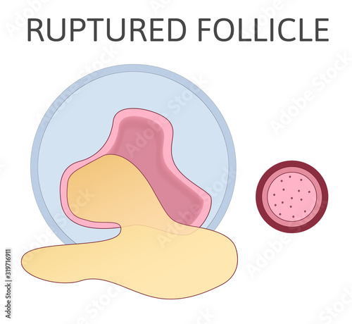 Ruptured follicle. Stage of developing follicle. Ovulation.