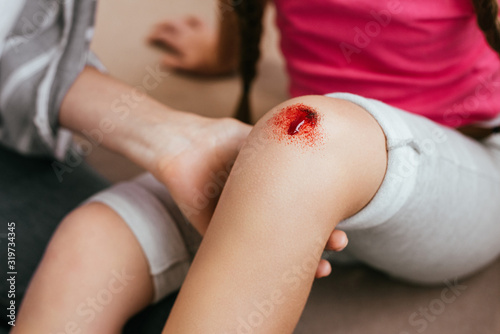 cropped view of mother holding daughters leg with wound on knee