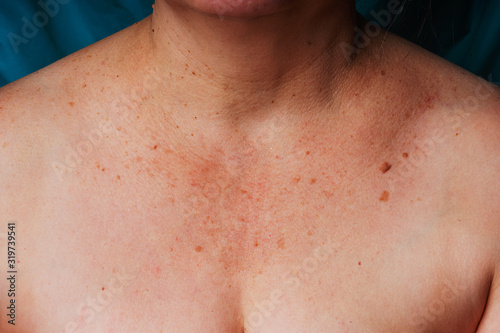 Age spots, moles and freckles on the neck and chest of an older woman. Spots on the body. Decollete area neckline of an elderly woman