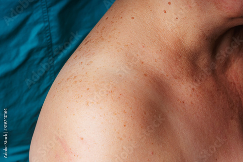 Age Spots Moles And Freckles On The Shoulders And Back Of An Older Woman Pigmentation On The Shoulder Spots On The Body Stock Photo Adobe Stock Age Spots Moles And Freckles On The Shoulders And Back Of An Older Woman Pigmentation On The Shoulder Spots On The Body Stock Photo Adobe Stock