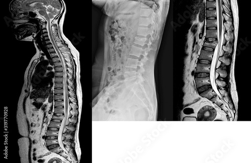 Lumbar spine lateral views x-ray and mri scan showing compression fracture of L2.