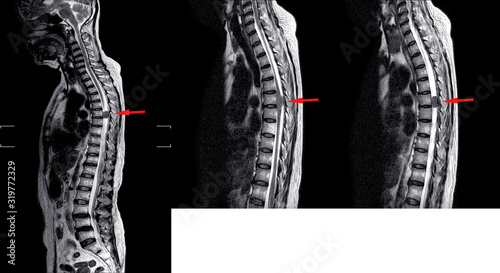 MRI TL spine  .History:Case back pain radiate to buttock and legs finding intradural and  extramedullary mass T6 spine on arrow point. photo