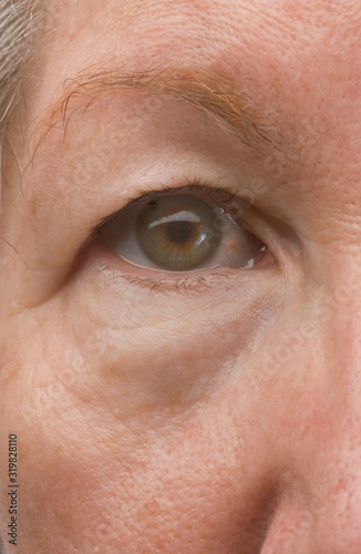 Εκτύπωση καμβά The right  eye of a woman showing a drooping eye lid.