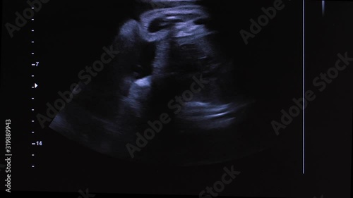 Close-up of ultrasound screen showing image of fetus in pregnant woman's womb during prenatal diagnostics in hospital. Moving ultrasound picture of unborn child in third trimester of pregnancy