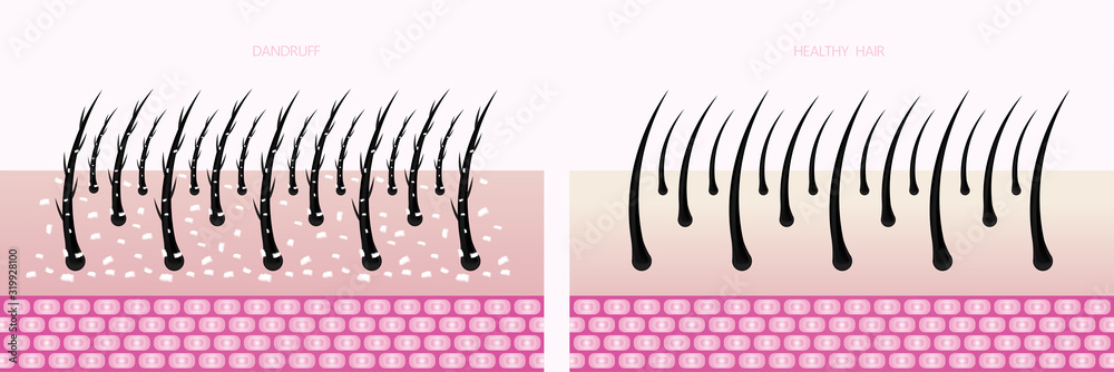 Hair problem and hair protect and care technology concept vector illustration. Hair problem and hair protect and care technology concept vector illustration.
