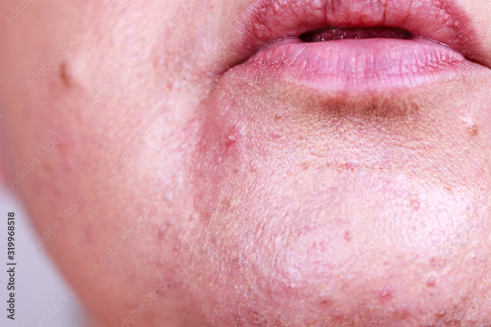 Obraz premium Female face with acne skin problem