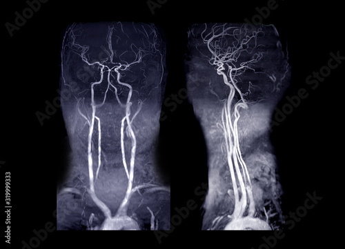 MRA Brain and neck or Magnetic resonance angiography ( MRA ) of cerebral artery and common carotid artery AP and Lateral View for evaluate them stenosis and stroke disease.