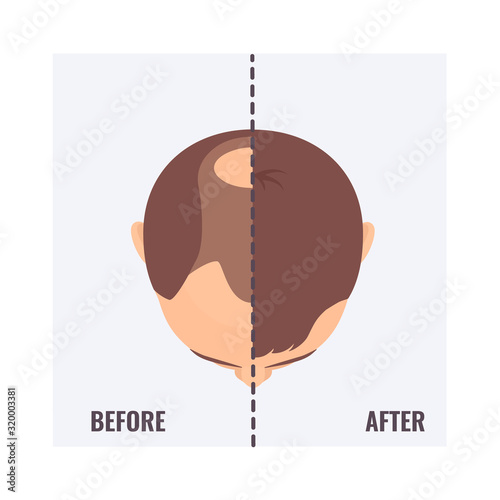 Top view portrait of a man before and after hair treatment and transplantation. Divided image of a man's head with alopecia and restored hairline. Two halves. Beauty concept. Vector illustration.