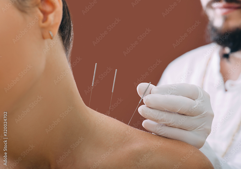Needles for acupuncture in a woman's shoulder close-up on a brown background. A reflexologist very accurately doing acupuncture