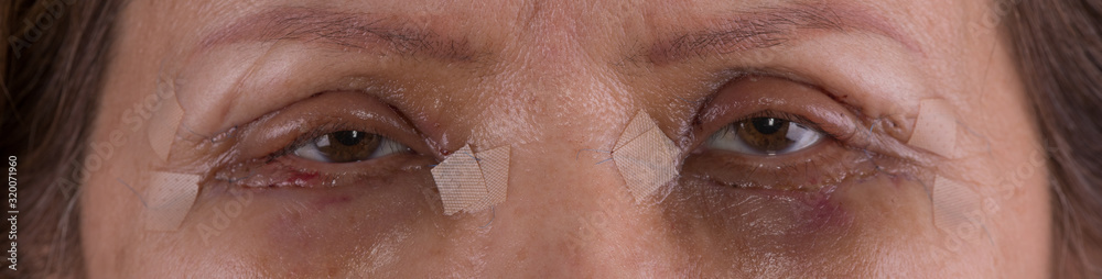 Eyes of an old woman after plastic surgery,blepharoplasty,eye bag removal Eyes of an old woman after plastic surgery,blepharoplasty,eye bag removal